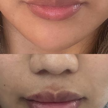 Snatched Beverly Hills - Top is fully dissolved and bottom is right after new filler (: - Medical Spas Near Me - Beverly Hills, California