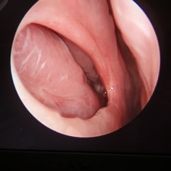 Boise ENT - After septum surgery