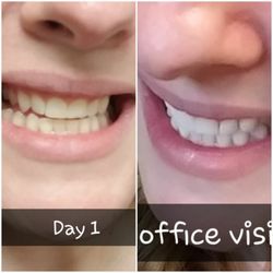 Pearl Dental Center - Before and after teeth whitening. Amazing!