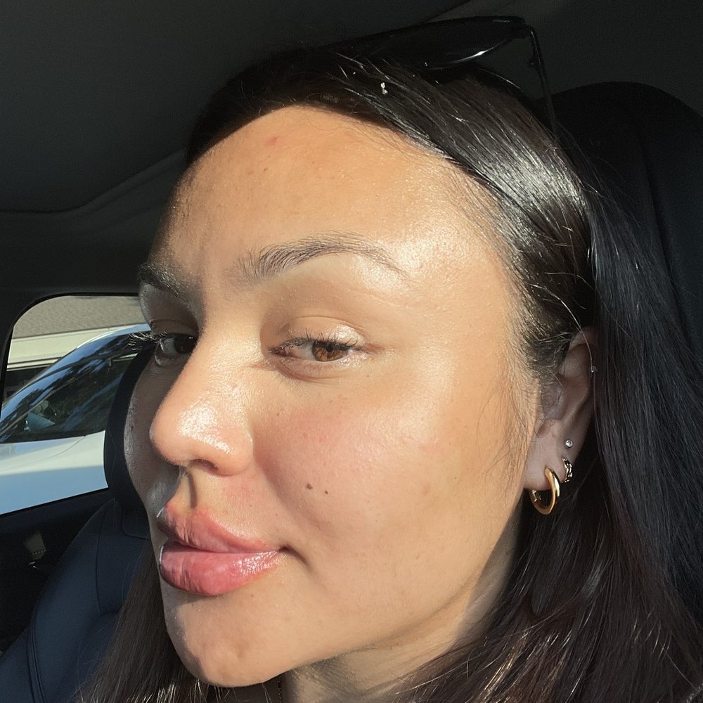 California Cosmetics - Day 1: Immediately after. Juvederm Ultra for Lips - Medical Spas Near Me - Newport Beach, California California Cosmetics - Day 1: Immediately after. Juvederm Ultra for Lips - Medical Spas Near Me - Newport Beach, California