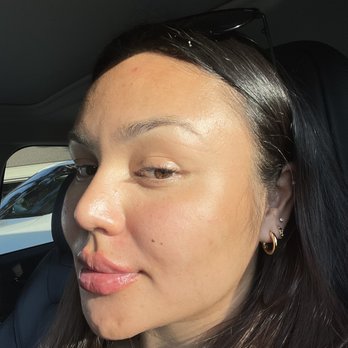 California Cosmetics - Day 1: Immediately after. Juvederm Ultra for Lips - Medical Spas Near Me - Newport Beach, California