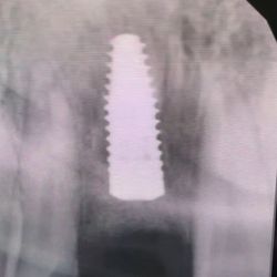 Bruce M Crawford, DMD - Implant