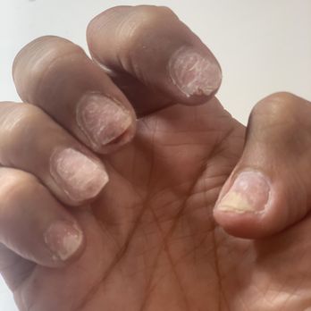 Bedazzled Nails and Spa - After the removal... What we were working with after two bad breaks - Waxing Near Me - Chicago, Illinois