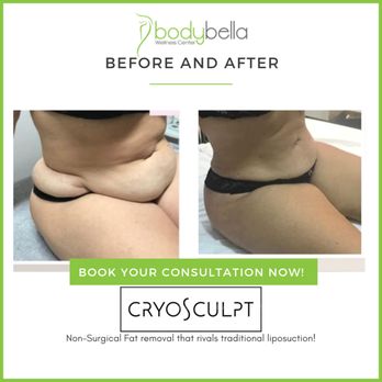 Body Bella Wellness Center - CryoSculpt 45 day before and after of abdomen - Medical Spas Near Me - Mableton, Georgia Body Bella Wellness Center - CryoSculpt 45 day before and after of abdomen - Medical Spas Near Me - Mableton, Georgia