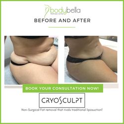 Body Bella Wellness Center - CryoSculpt 45 day before and after of abdomen
