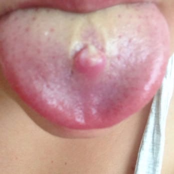 Blancolo Body Piercing & Tattooing - This is the colour my tongue has gone and how the lump looks - Tattoo Near Me - Glasgow, GLG