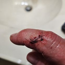 Jones Regional Medical Center Family Medicine - Anamosa - Open wound above stitches