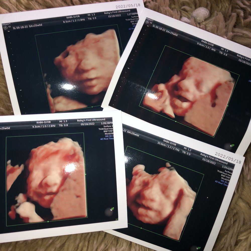Baby's First Ultrasound - Our smiley baby girl - Diagnostic Imaging Near Me - Riverside, California