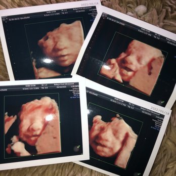 Baby's First Ultrasound - Our smiley baby girl - Diagnostic Imaging Near Me - Riverside, California