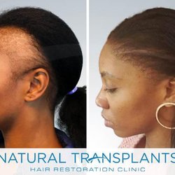 Natural Transplants, Hair Restoration Clinic
