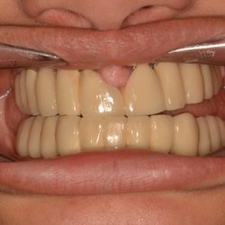 National Dental Bronx - Here are the teeth that I paid $40,000 for!  Who the nurse said "LOOKS GREAT!"