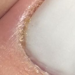 Infection