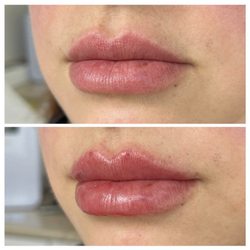 Ageless Image - One syringe of filler gives the perfect plump!