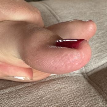 Ridgeline Nail - Pedicure damaged foot - Nail Salons Near Me - Colorado Springs, Colorado