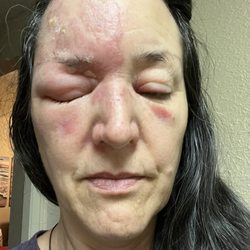 Austin Infectious Disease - First day admittance - could not open eyes all the way.
