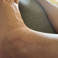 In Motion O.C. - 13.5 weeks post ankle surgery