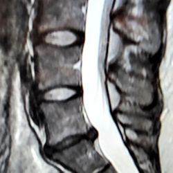 UMR - Disc degeneration MRI
