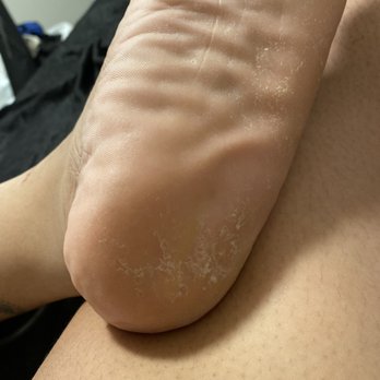 Best Nail Salon - My foot after pedicure , still plenty dead skin - Waxing Near Me - Baton Rouge, Louisiana