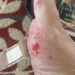 How my foot looked when I arrived home.