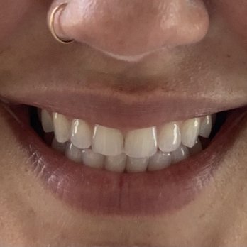 SmileyTeethSD - Before - Teeth Whitening Near Me - San Diego, California SmileyTeethSD - Before - Teeth Whitening Near Me - San Diego, California