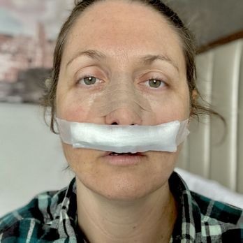 Nasal & Sinus Center: Parul Goyal, MD - Post op immediately - Ear Nose & Throat Near Me - Syracuse, New York Nasal & Sinus Center: Parul Goyal, MD - Post op immediately - Ear Nose & Throat Near Me - Syracuse, New York