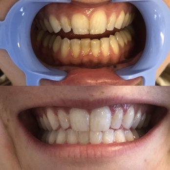 Next Level Teeth Whitening and Spray Tan - Before and after - Spray Tanning Near Me - Glendale, Colorado Next Level Teeth Whitening and Spray Tan - Before and after - Spray Tanning Near Me - Glendale, Colorado