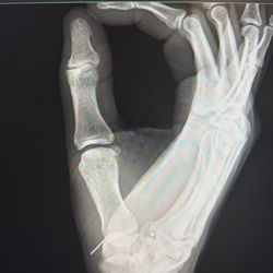 MultiCare Indigo Urgent Care - X-ray machine that was able to display bones and metal.