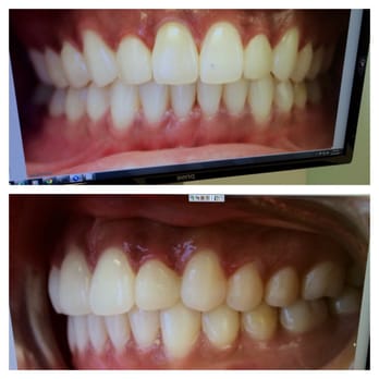 Rittenhouse Orthodontics - This is exactly when I got my braces removed (the after photo). When I find the before photos I will post a few. - Orthodontists Near Me - Philadelphia, Pennsylvania Rittenhouse Orthodontics - This is exactly when I got my braces removed (the after photo). When I find the before photos I will post a few. - Orthodontists Near Me - Philadelphia, Pennsylvania