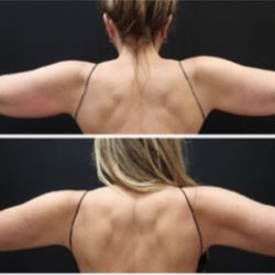 Natural Rejuvenation MedSpa - Body FX and Accufit for more toned arms