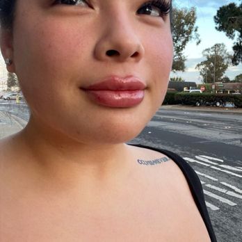 SVIA MedSpa San Mateo - 10 minutes after my lip filler appointment - Skin Care Near Me - San Mateo, California SVIA MedSpa San Mateo - 10 minutes after my lip filler appointment - Skin Care Near Me - San Mateo, California