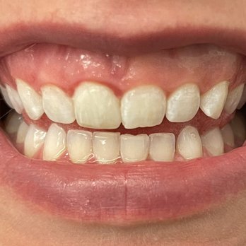 DaVinci Blanch teeth whiting  - Teeth Whitening Near Me - Highlands Ranch, Colorado