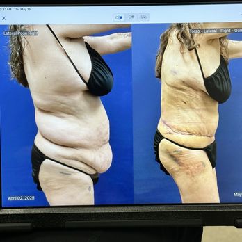 Sono Bello Ontario - Side view - Cosmetic Surgeons Near Me - Ontario, California