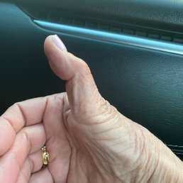 It looks worse over time and is painful still. Jefferey stop performing Thumb joint replacement It looks worse over time and is painful still. Jefferey stop performing Thumb joint replacement