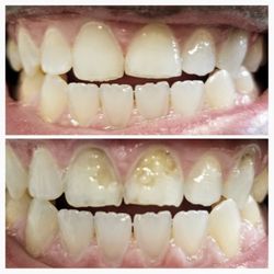 Smiles By Gentle Dental - Before and after