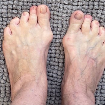 Desert Orthopedic Center - Feet before left foot 3D Bunion Lapiplasty and 3 toes surgery - Orthopedists Near Me - Rancho Mirage, California Desert Orthopedic Center - Feet before left foot 3D Bunion Lapiplasty and 3 toes surgery - Orthopedists Near Me - Rancho Mirage, California