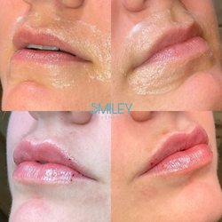 Smiley Aesthetics - A perfect set of lips.