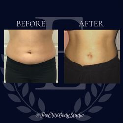Elite Body Studio - Amazing results on client, she was able to achieve this with 7 sessions of ultrasound cavitation, vacuum therapy, and radio frequency.