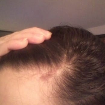 770 Salon Miami - One of many burns courtesy of the inexperienced stylists. - Hair Salons Near Me - Miami, Florida