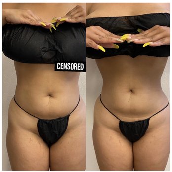 Rejuven8 OC - Left pic: no treatment Right pic: 1st treatment - Body Contouring Near Me - Newport Beach, California Rejuven8 OC - Left pic: no treatment Right pic: 1st treatment - Body Contouring Near Me - Newport Beach, California