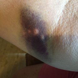 Morristown-Hamblen Healthcare System Emergency Room - Bruised from bad experience with getting blood drawn.