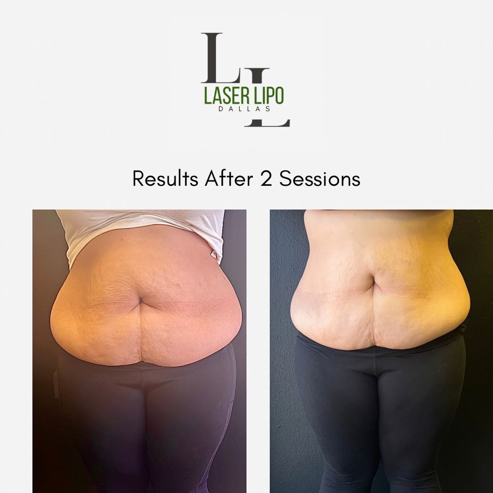 LASER LIPO DALLAS 4230 Lyndon B Johnson Fwy, Dallas, Texas Body