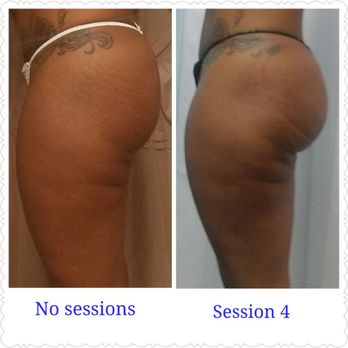 Bodies Made By Bri - Non-invasive Butt Lift- Using Radio Frequency, Vacuuming, and Cupping of the buttocks. - Body Contouring Near Me - Missouri City, Texas Bodies Made By Bri - Non-invasive Butt Lift- Using Radio Frequency, Vacuuming, and Cupping of the buttocks. - Body Contouring Near Me - Missouri City, Texas