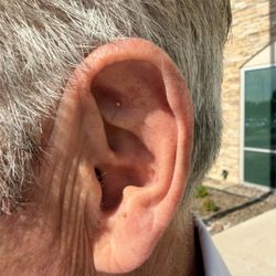Department Of Veteran Affairs - Battlefield acupuncture