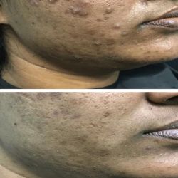 Pigmentation/scars left behind from acne don't have to be permanent reminder. Get clear sooner Vs later today!