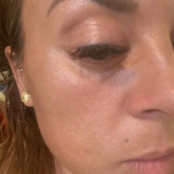 Bombshell Aesthetics - A month after threads - Medical Spas Near Me - Hayward, California Bombshell Aesthetics - A month after threads - Medical Spas Near Me - Hayward, California