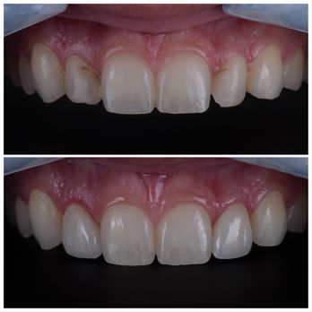 Marlton Dental Care - 2 veneers on lateral incisors - General Dentistry Near Me - Marlton, New Jersey Marlton Dental Care - 2 veneers on lateral incisors - General Dentistry Near Me - Marlton, New Jersey