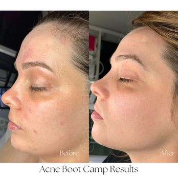 AG Esthetics - Acne Boot Camp Results - Skin Care Near Me - Spring, Texas AG Esthetics - Acne Boot Camp Results - Skin Care Near Me - Spring, Texas