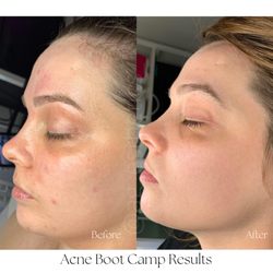 AG Esthetics - Acne Boot Camp Results