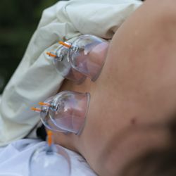 Michelle Orchid Rodriguez,LMBT - Cupping therapy