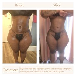 Alluring Silhouette & Holistics - Before & After Lymphatic massage